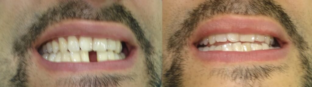 Provisional dientes - DIENTES POSTIZOS PROVISIONALES